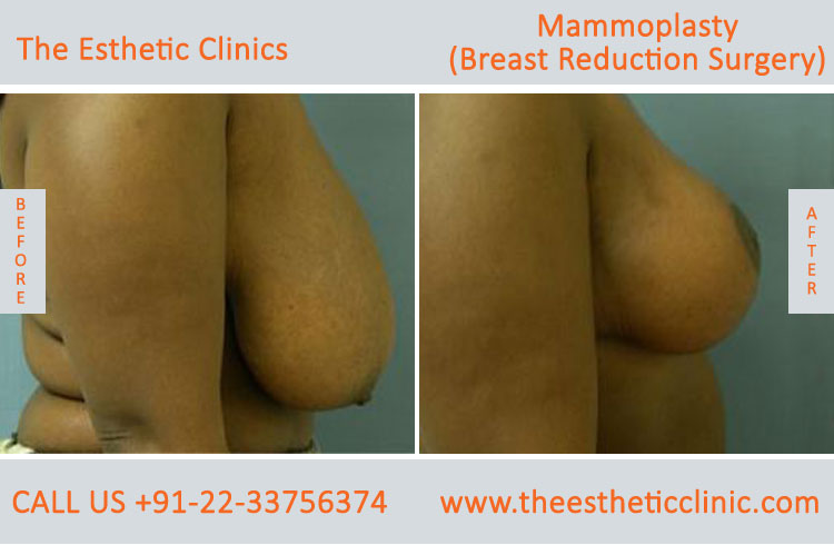 Mammoplasty, Breast Reduction Surgery before after photos in mumbai india (6)